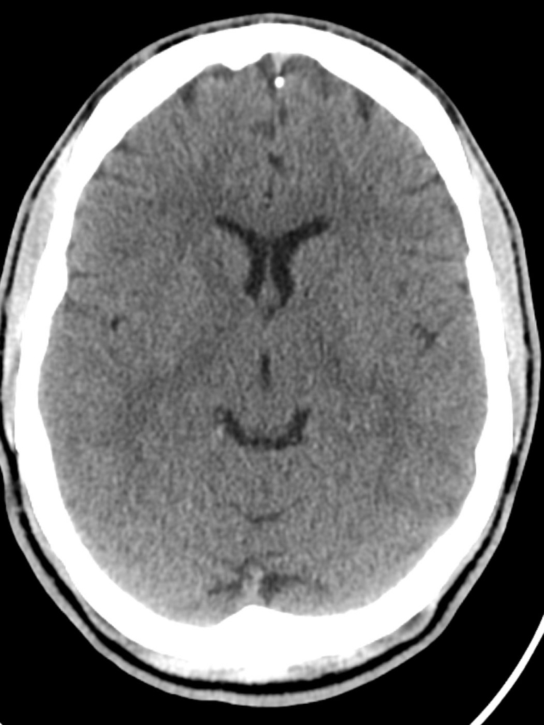 Beyin tomografisi 1