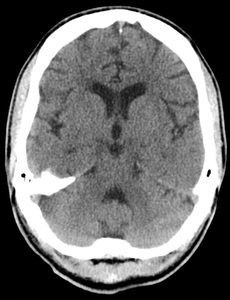 Beyin tomografisi 2